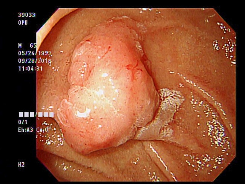 十二指腸息肉躲貓貓水中切除術除病灶 即時新聞 自由健康網