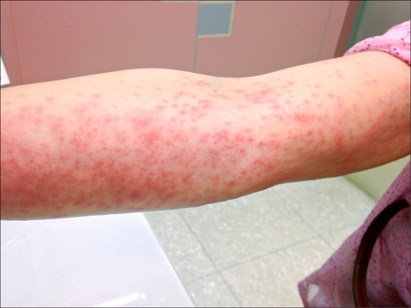 媽呀 毛毛蟲皮膚炎癢到睡不著 即時新聞 自由健康網