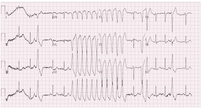 年輕健康女性突昏倒 心室頻脈 險奪命 即時新聞 自由健康網