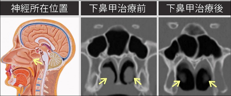 改良式微創手術擺脫惱人鼻過敏 即時新聞 自由健康網