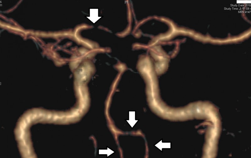 男子一健身就頭痛檢查才知 雷擊性頭痛 即時新聞 自由健康網