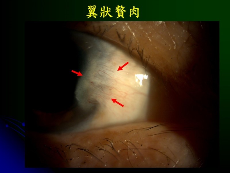 眼球有硬皮長贅肉 別低估這原因 即時新聞 自由健康網