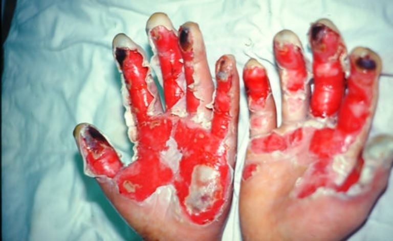 氫氟酸造成的傷害常見於手部，圖為遭氫氟酸灼傷傷勢圖，與本案無關。（記者鄭名翔翻攝）