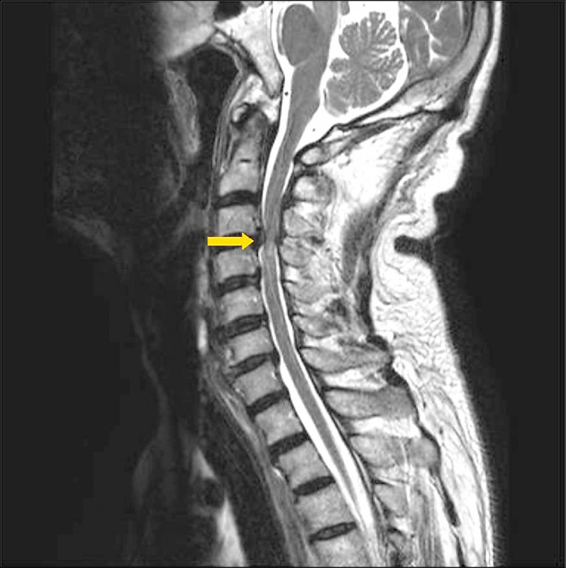 黏3c壓迫頸椎輕則頭痛重恐癱瘓 即時新聞 自由健康網