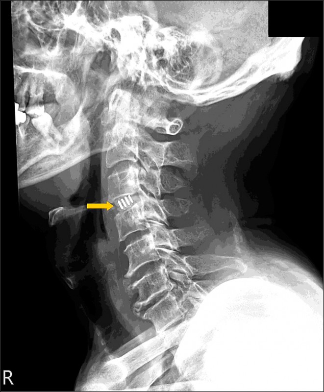 黏3c壓迫頸椎輕則頭痛重恐癱瘓 即時新聞 自由健康網