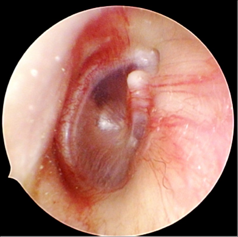 中耳炎積膿竟撐破耳膜流湯 即時新聞 自由健康網