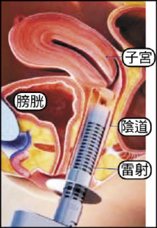 腾讯医典 前壁膨出是怎么造成的 恩芝网