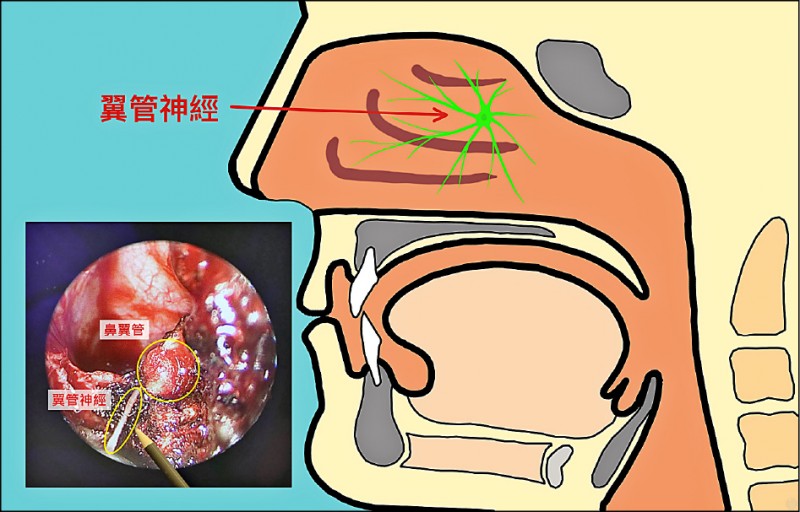 改良式翼管神經截斷手術擺脫鼻過敏 即時新聞 自由健康網