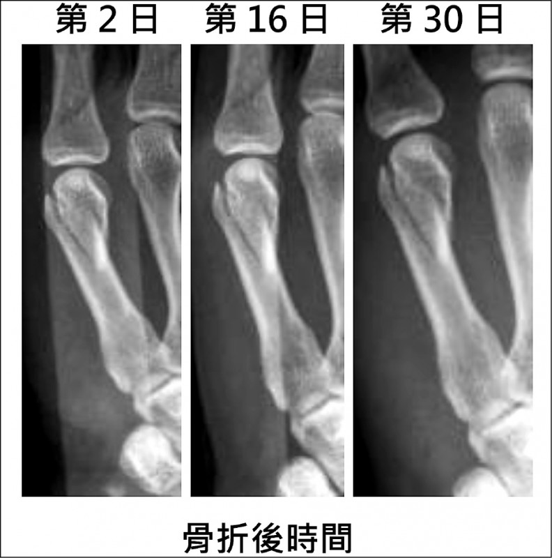 骨折第一週需立即正骨制動 即時新聞 自由健康網