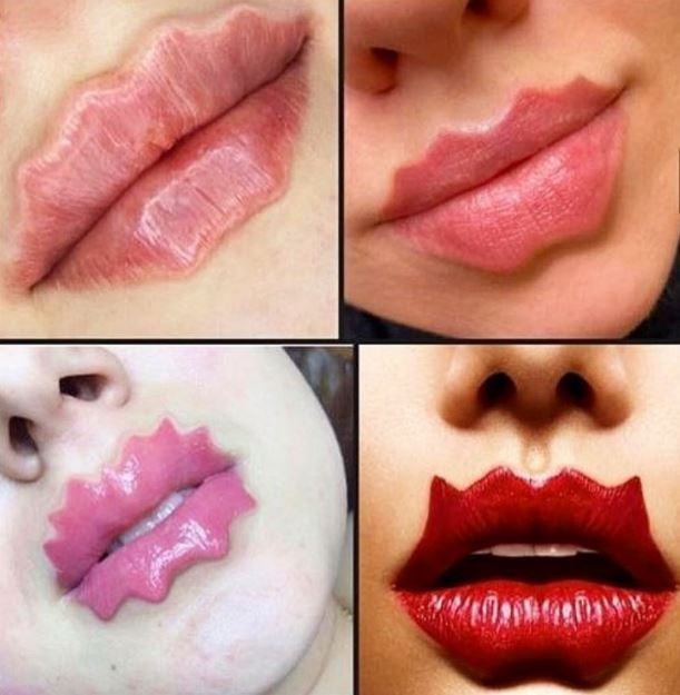 俄羅斯近日開始流行「唇部整型」，藉由施打填充物，讓唇部呈現「波浪型」或「多角形」，被稱為「惡魔嘴唇」或「章魚嘴唇」；但醫學美容專家警告千萬別亂打填充物。（圖擷取自 @dradeborasats）