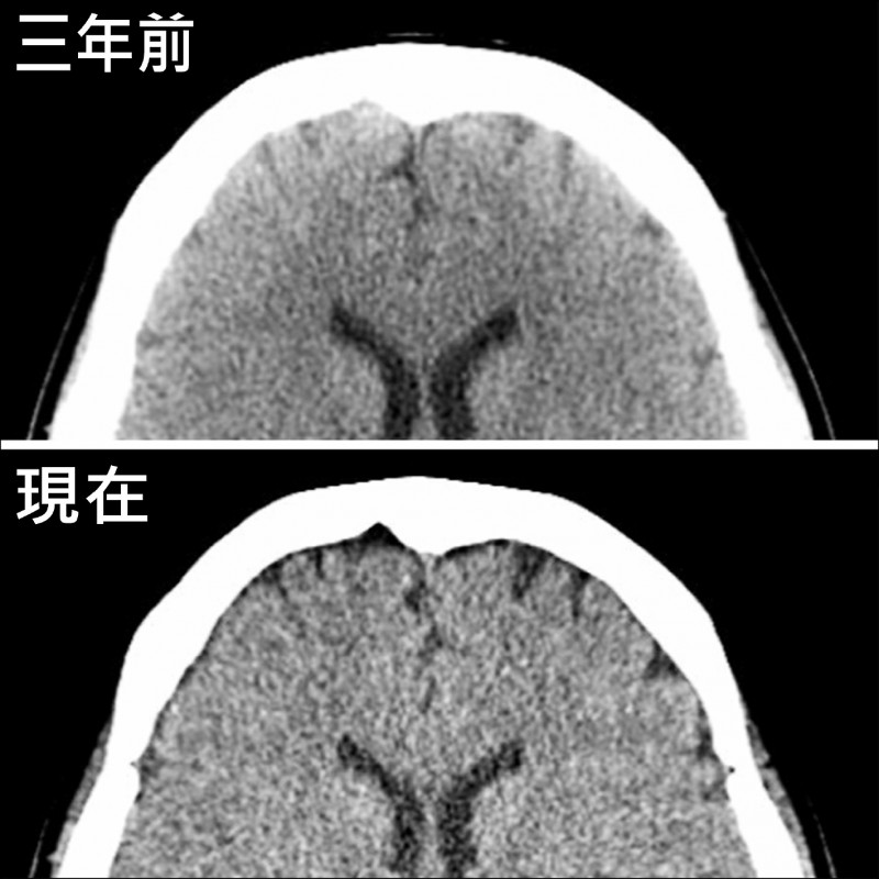 ▲電腦斷層顯示,患者現在腦部兩側前方大腦實質和顱骨間,較3年前出現較大空隙,顯示腦萎縮。(照片提供/陳彥文)
