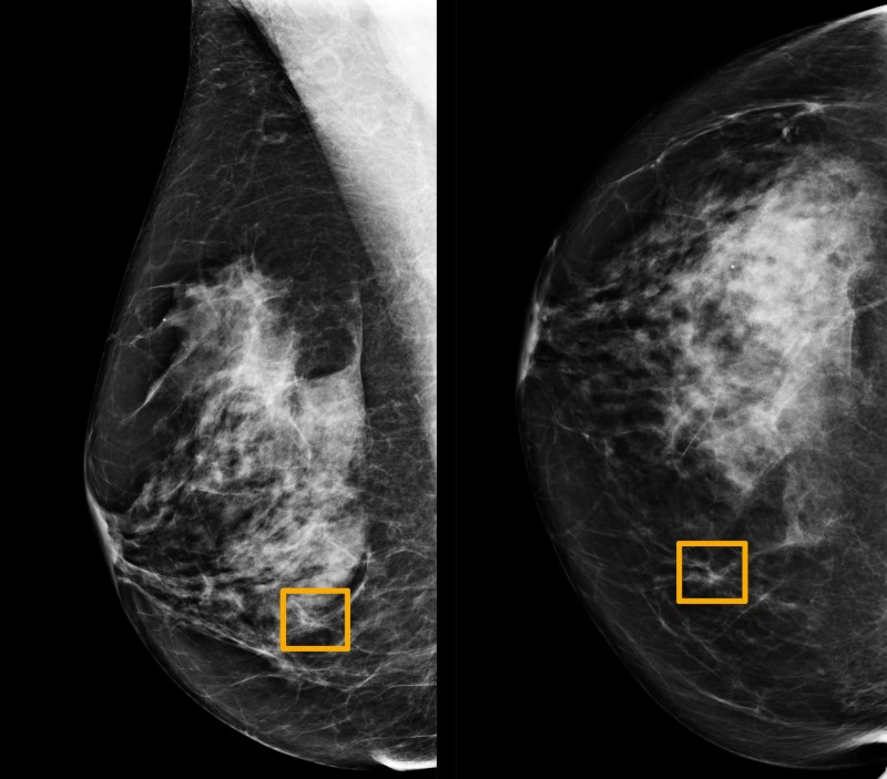 研究指出，AI判讀乳癌的準確率已等同2名專業醫師。黃色方框為AI辨認出的乳癌細胞處。（路透）