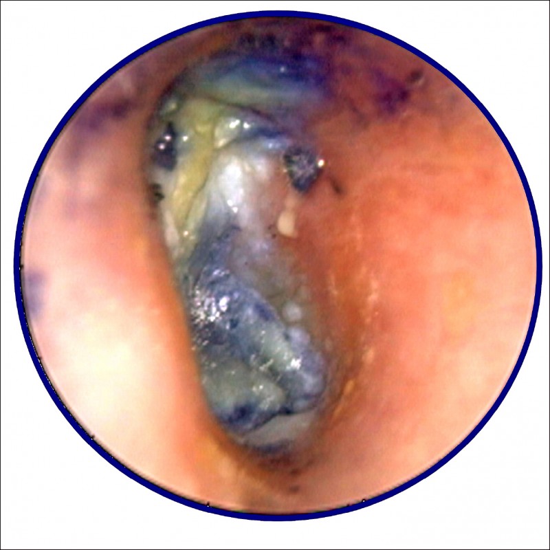 胡亂掏耳掏出急性黴菌性耳膜炎 即時新聞 自由健康網