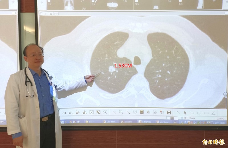黃丞正指張先生右上肺葉有1.5公分大的肺癌。（記者蔡淑媛攝）