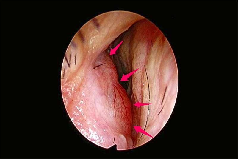 右鼻孔腫腫中年婦罹鼻唇囊腫 即時新聞 自由健康網