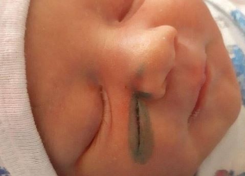俄羅斯近日卻有名19歲的新手媽媽因腹中的女兒胎位不正，聽從醫師建議後選擇「剖腹產」，但產後醒來，卻發現女兒臉上有一道約3公分的刀傷。（圖擷取自VK @ТРЕВОЖНЫЕ НОВОСТИ）