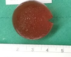 新竹市一名1歲多的幼童因誤食直徑0.6公分的水晶球，結果因水晶球膨脹卡在腸道，造成阻塞及疼痛，幸開刀取出水晶球後獲救治。（記者洪美秀翻攝）