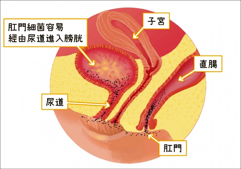 女性反覆泌尿道感染 不是妳的錯 即時新聞 自由健康網