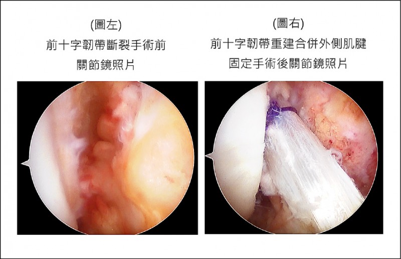 前十字韌帶重建 新療法關節鏡輔助合併外側肌腱固定 即時新聞 自由健康網