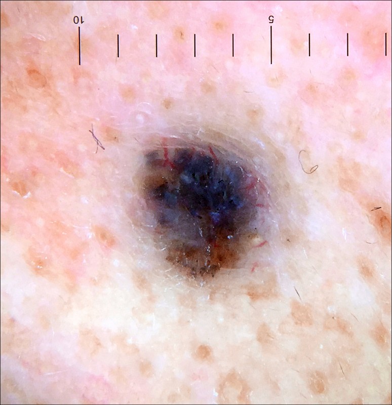 要除黑痣先檢查有無惡性變化 美顏抗老 自由健康網