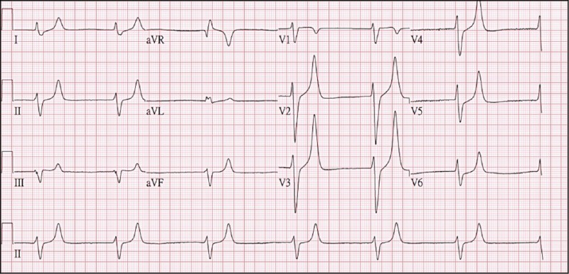 腎病婦香蕉不忌口高血鉀致心律過緩 即時新聞 自由健康網