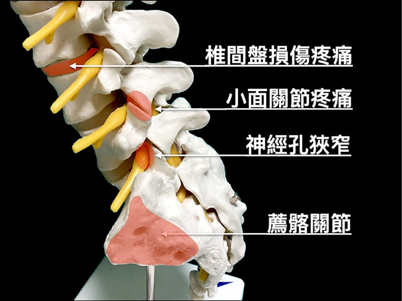 為何下背痛骨刺未必是元凶 即時新聞 自由健康網