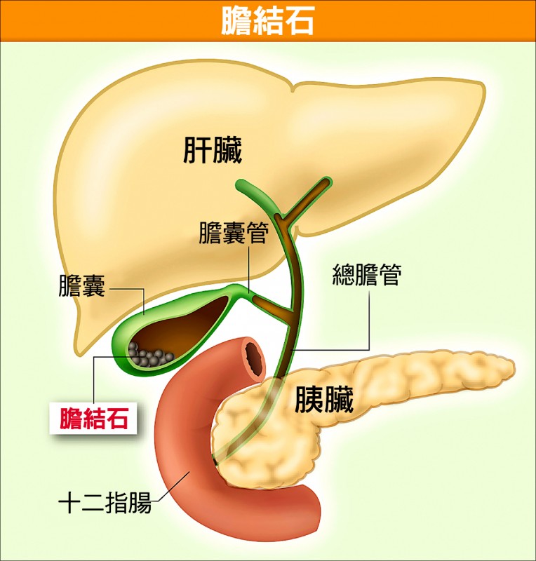 愛肝加油站 膽結石併發急性膽囊炎需緩解發炎再切除膽囊 即時新聞 自由健康網