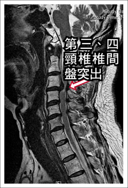 做磁共振 颈椎3 4节突出还压迫到了神经 该怎么办 知乎