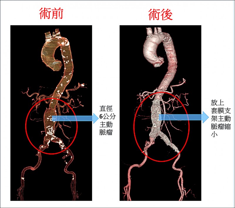 心臟掉到肚子 原來是腹主動脈瘤 即時新聞 自由健康網