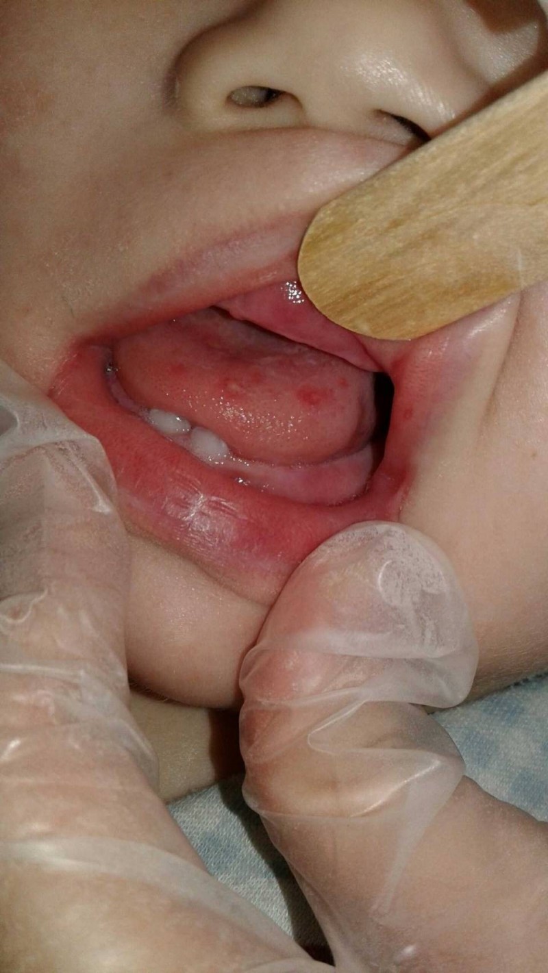 ９個月大男嬰罹患腸病毒，手足口症不典型，口腔潰瘍、水泡多在舌頭，而不是一般的在咽峽部。（記者蔡淑媛翻攝）