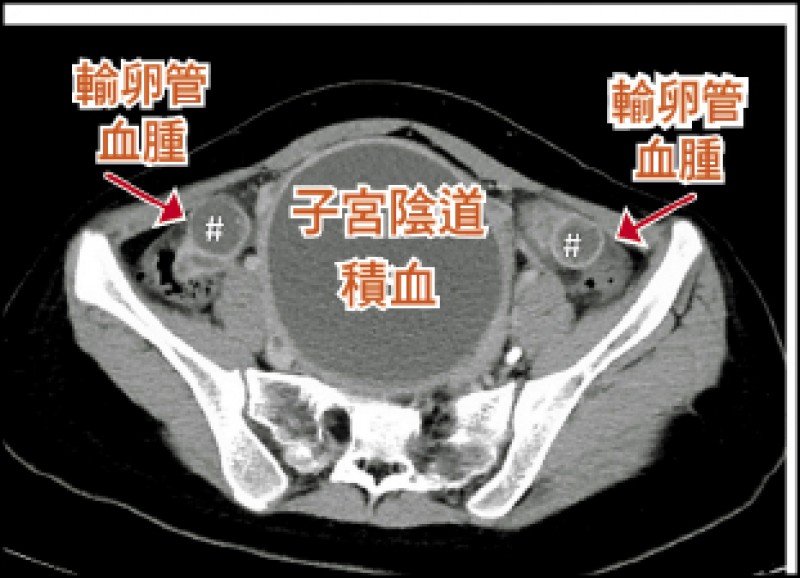 少女腹痛尿不出竟是處女膜閉鎖 即時新聞 自由健康網