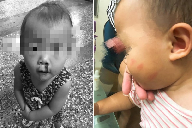 台東公立托嬰中心托育人員傳不當照顧，將爆哭的托育幼童抱往廁所打紅臉頰（右），孩子5天內流了3次鼻血（左），家長氣憤難平。（記者陳賢義翻攝，左圖經變色處理）