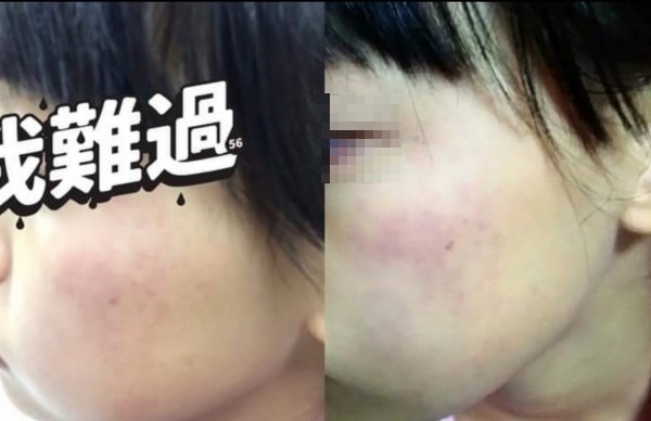 小四女童家長PO出女兒遭安親班女老師要求自己掌嘴200下的臉頰紅腫畫面。（翻攝資料照）