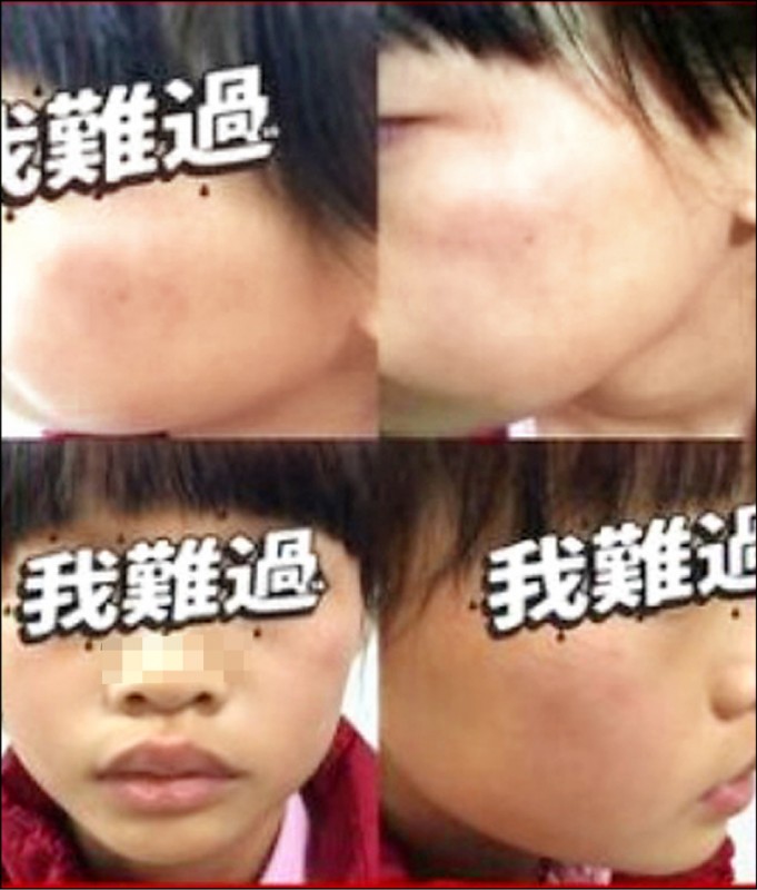 一名小四女童的家長上網po文貼出女兒遭安親班女老師要
求自己掌嘴二百下的臉頰紅腫畫面。 （取自網路社群）