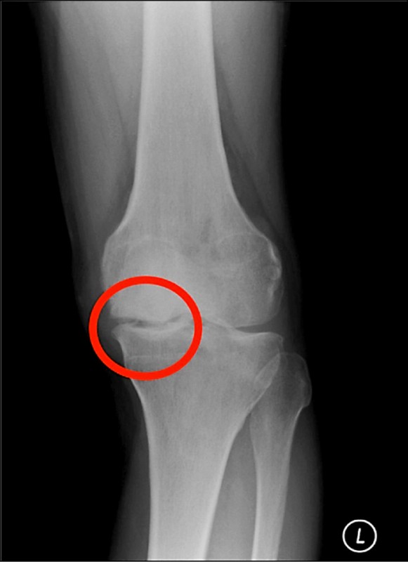 O型腿車禍傷膝雙管齊下免換人工關節 即時新聞 自由健康網
