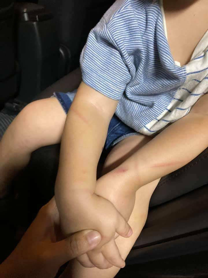 一名男童身上有多處傷痕，據說是疑似吵到保母男友睡覺，因此被保母男友痛打。（記者王捷翻攝）
