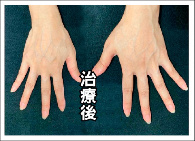 類風濕性關節炎及早治療避免關節破壞失能 即時新聞 自由健康網
