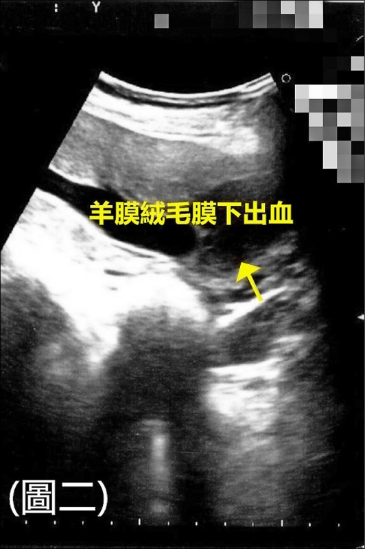 認識懷孕出血保胎不留遺憾 自由健康網