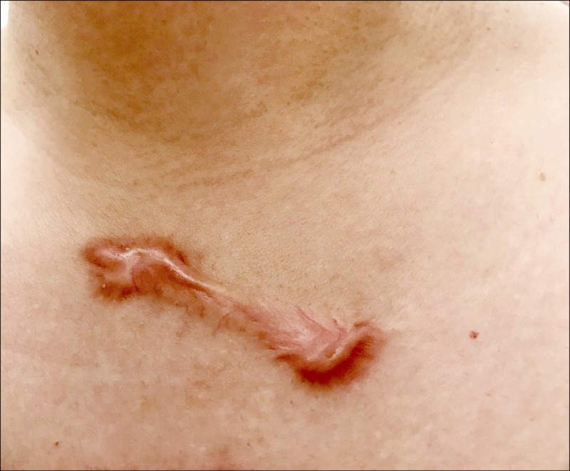 蟹足腫反覆發作手術 放療 根治 美顏抗老 自由健康網