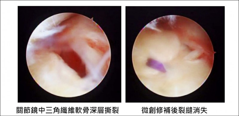 手腕受傷無力腕關節鏡微創術助復元 即時新聞 自由健康網