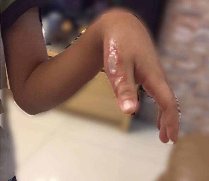 女童摔傷導致左拇指挫傷，遭醫院通報疑似家暴。（家長提供）