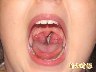 兒童罹睡眠呼吸中止症長期恐造成血壓升高 學習力與專注力降低 即時新聞 自由健康網