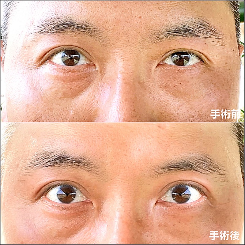 盯3c常揉眼加速眼瞼下垂 美顏抗老 自由健康網