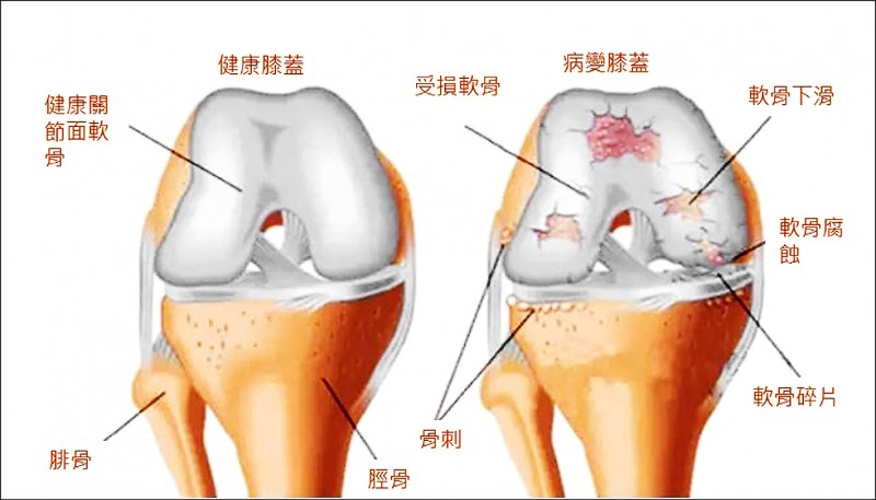 一次性自體軟骨修復術打造新膝望 即時新聞 自由健康網 一次性自體軟骨修復術打造新膝望 即時新聞 自由健康網