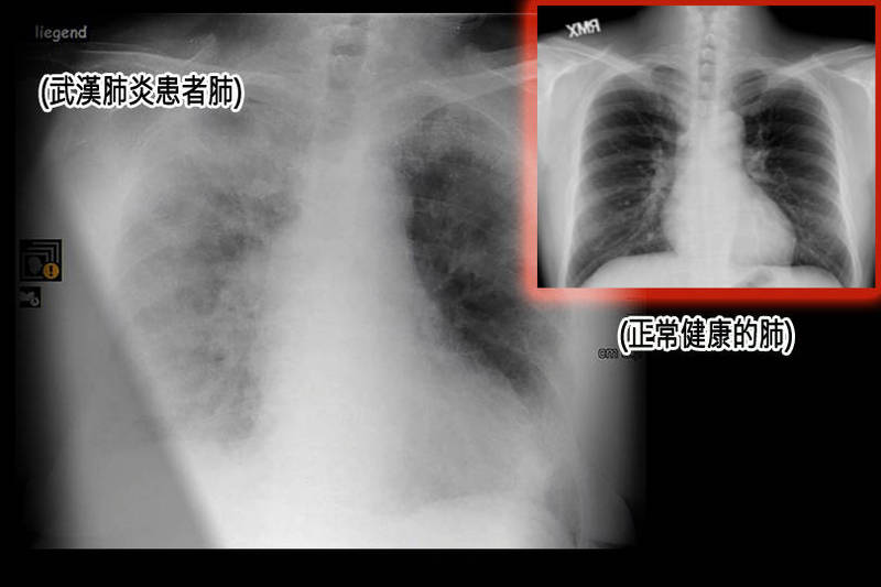 武汉肺炎患者X光照片呈现雾茫茫。大图为德国医院拍摄武汉肺炎X光照，小图为正常健康肺部。（大图路透，小图本报资料照，本报合成）(photo:LTN)