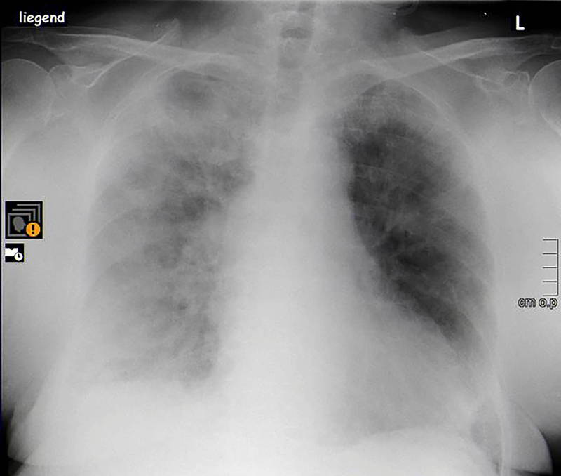 武汉肺炎患者X光照片呈现雾茫茫。（路透）(photo:LTN)
