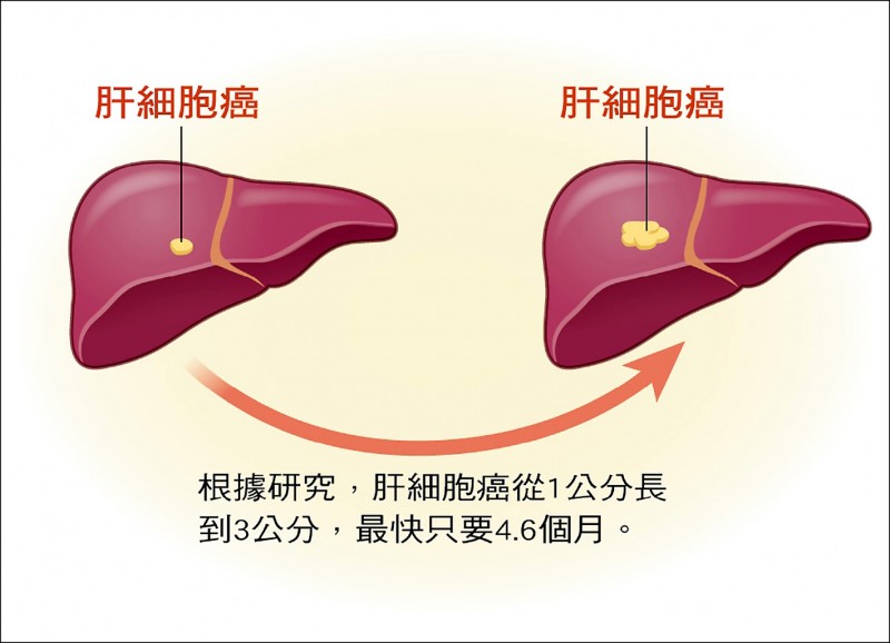 愛肝加油站 1公分肝癌長到3公分最快只需4 6個月 即時新聞 自由健康網