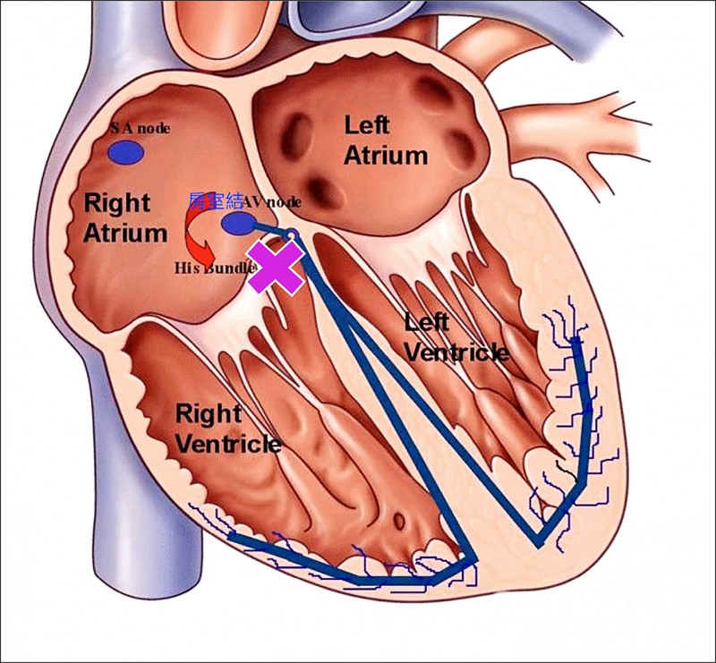 低輻射立體定位併冷凝燒灼 精準阻斷病灶26歲女揮別心律不整 新知傳真 自由健康網