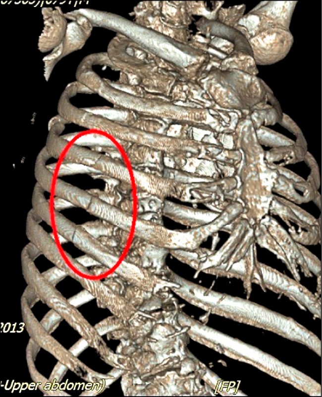 老翁肋骨9處骨折3d列印輔助快速重建 即時新聞 自由健康網