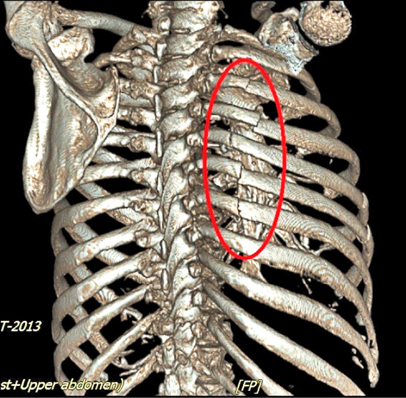 老翁肋骨9處骨折3d列印輔助快速重建 即時新聞 自由健康網